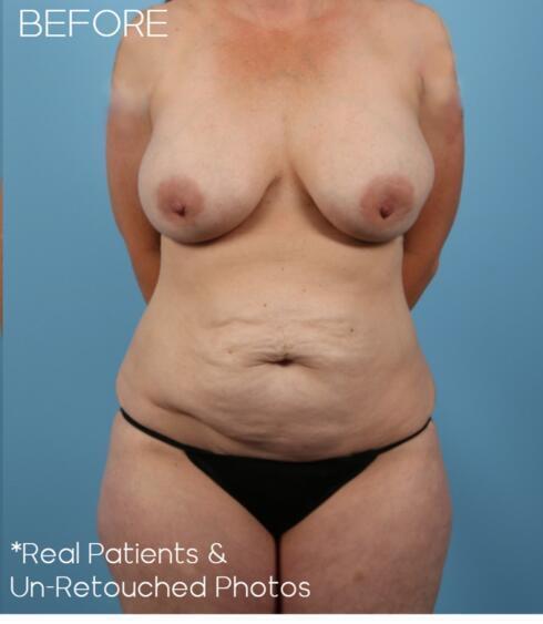 Abdominoplasty Before & After Image