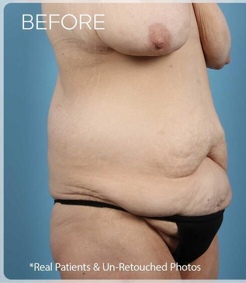 Abdominoplasty Before & After Image