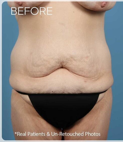 Abdominoplasty Before & After Image