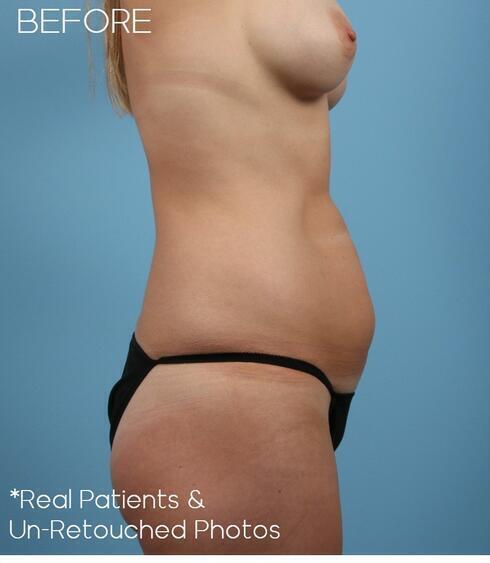 Abdominoplasty Before & After Image