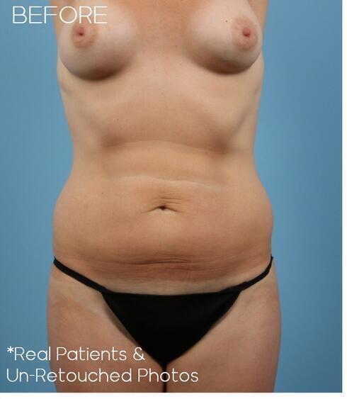 Abdominoplasty Before & After Image