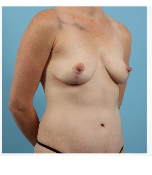 Abdominoplasty Before & After Image