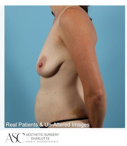 Abdominoplasty Before & After Image