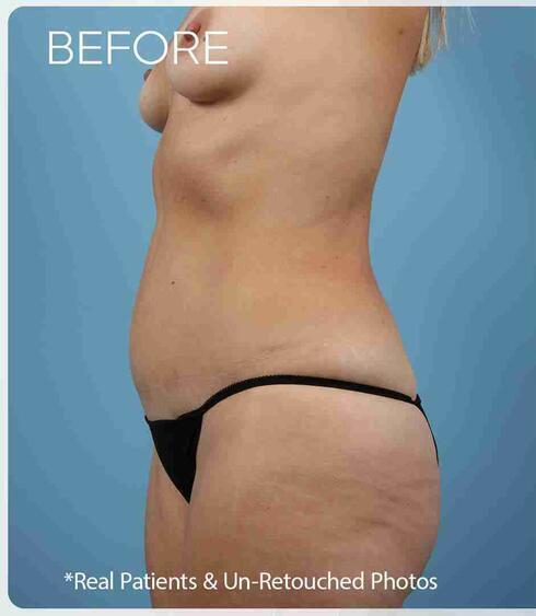 Abdominoplasty Before & After Image