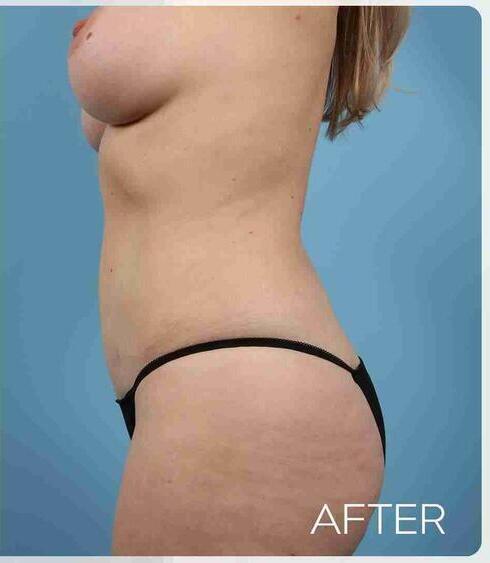 Abdominoplasty Before & After Image