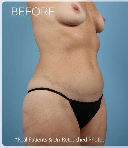 Abdominoplasty Before & After Image