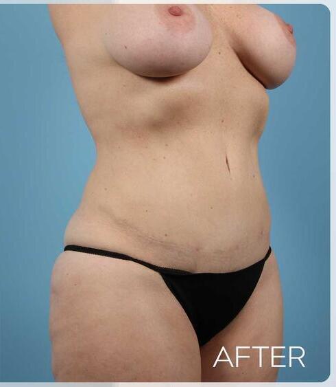 Abdominoplasty Before & After Image