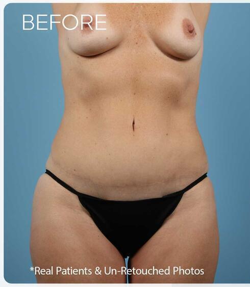 Abdominoplasty Before & After Image