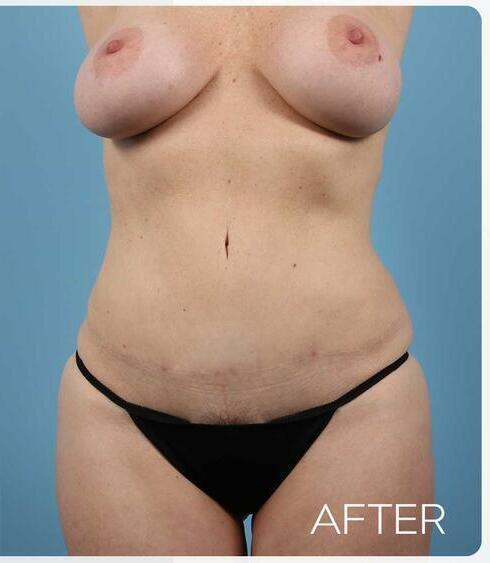 Abdominoplasty Before & After Image