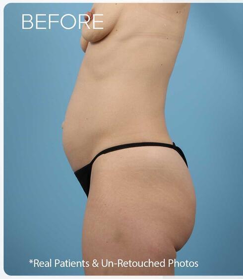 Abdominoplasty Before & After Image