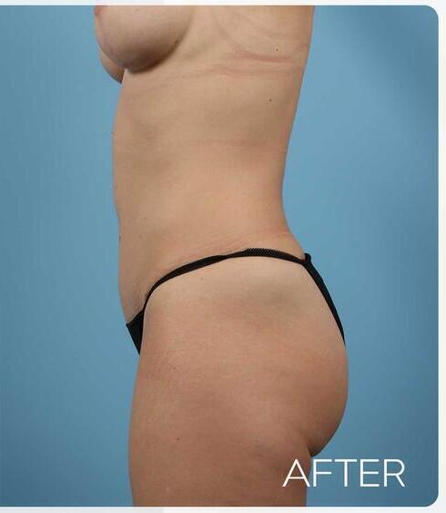 Abdominoplasty Before & After Image