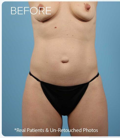 Abdominoplasty Before & After Image