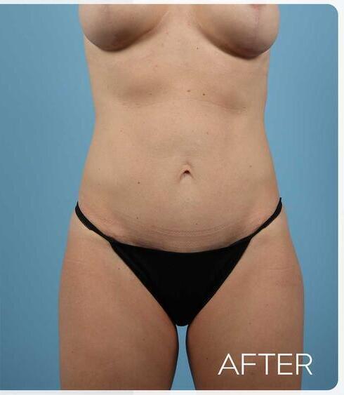 Abdominoplasty Before & After Image