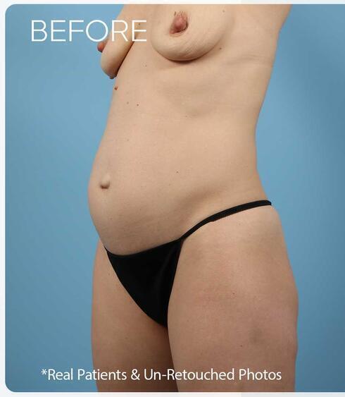 Abdominoplasty Before & After Image