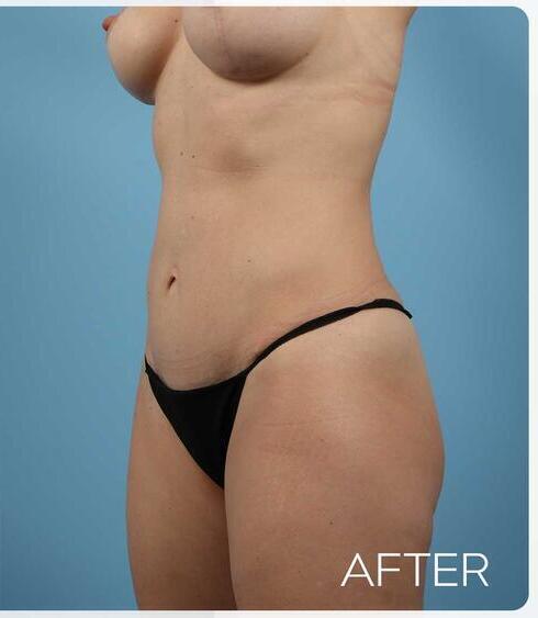 Abdominoplasty Before & After Image