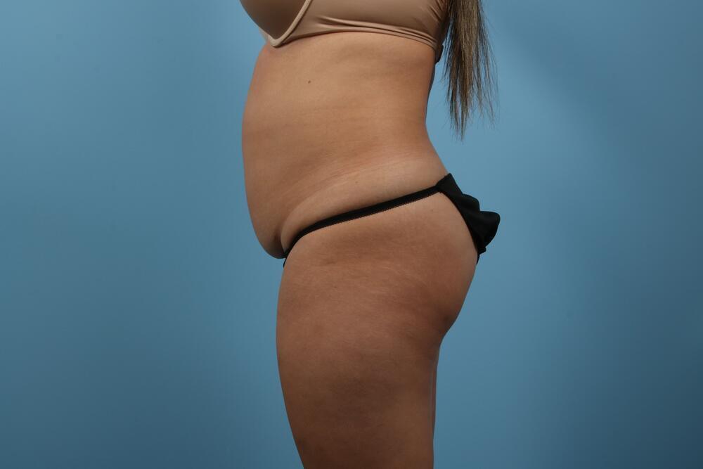 Abdominoplasty Before & After Image