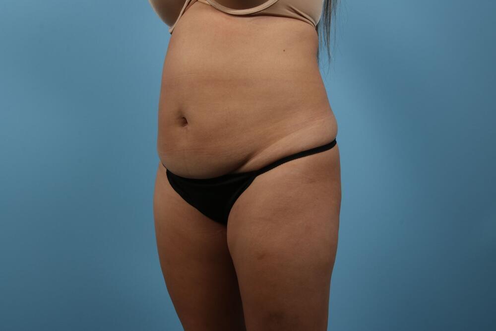 Abdominoplasty Before & After Image