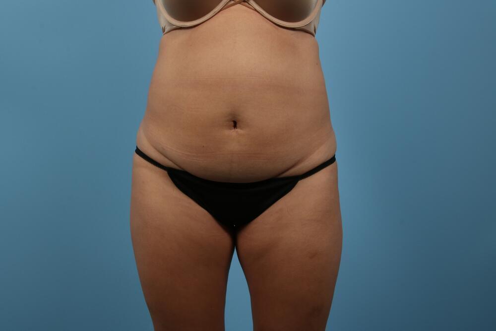 Abdominoplasty Before & After Image