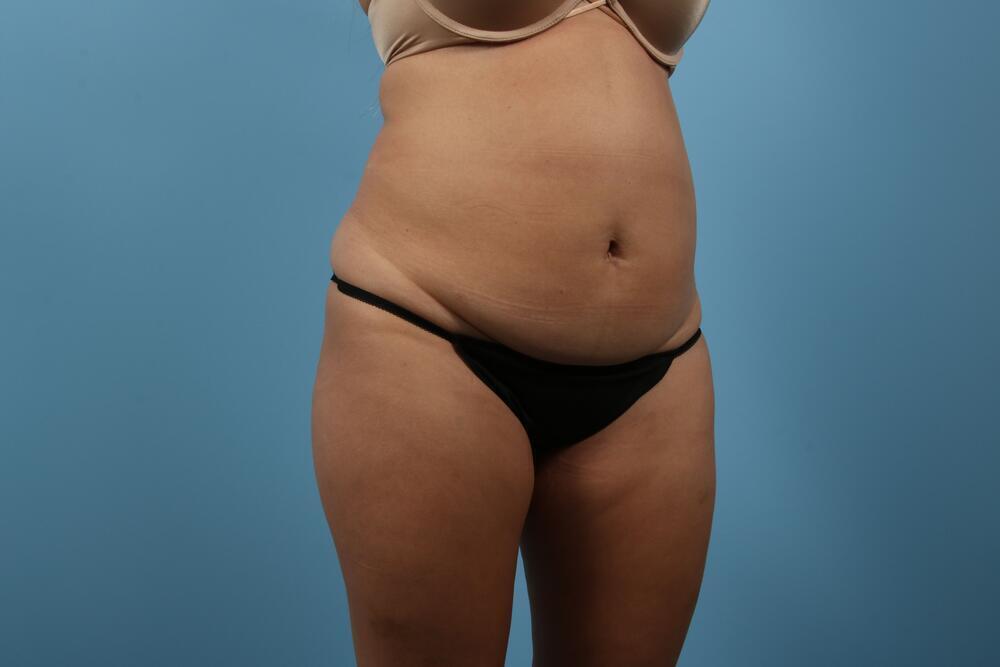 Abdominoplasty Before & After Image