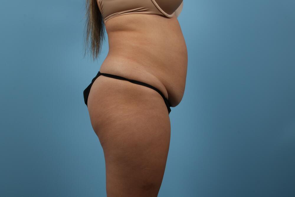 Abdominoplasty Before & After Image