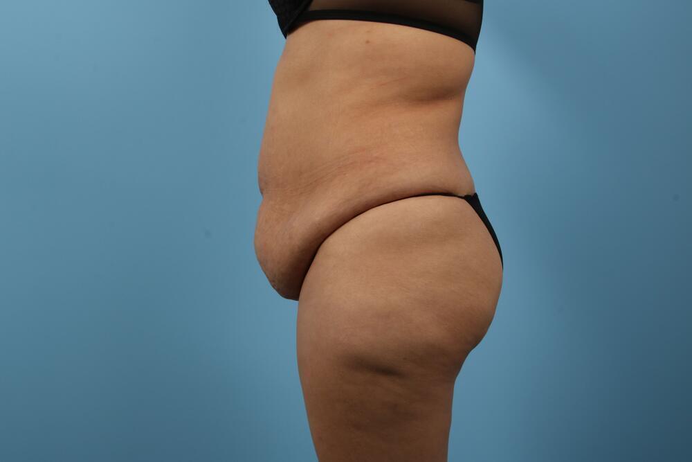 Abdominoplasty Before & After Image