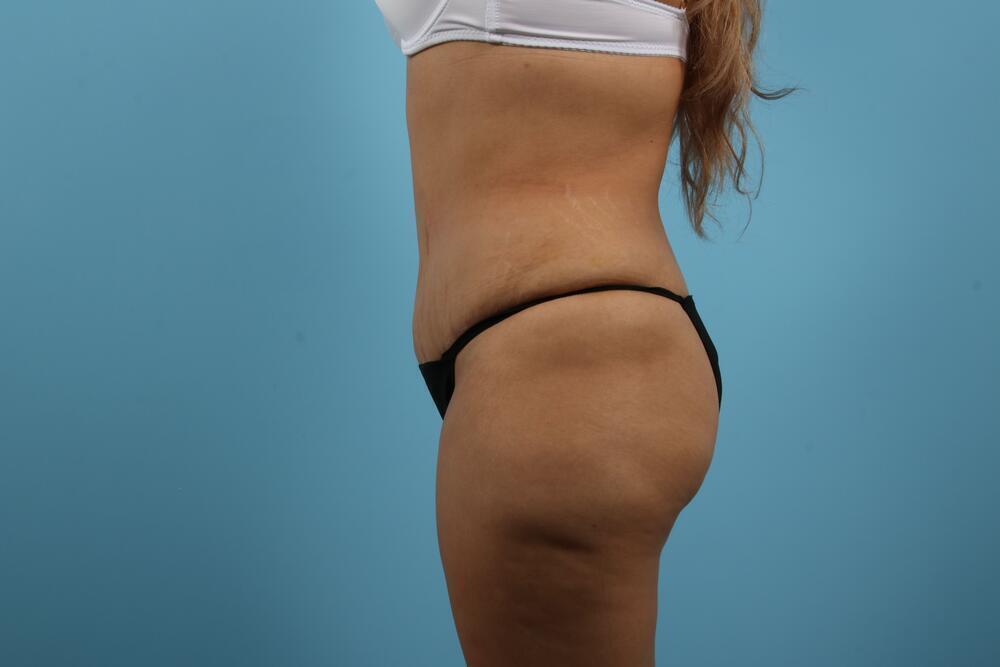 Abdominoplasty Before & After Image