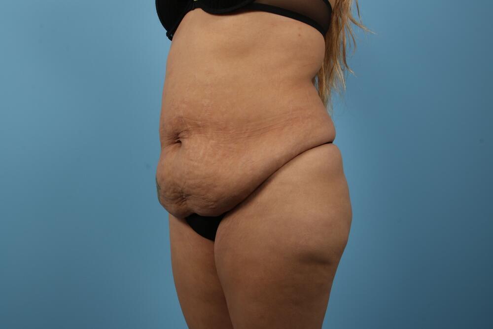 Abdominoplasty Before & After Image