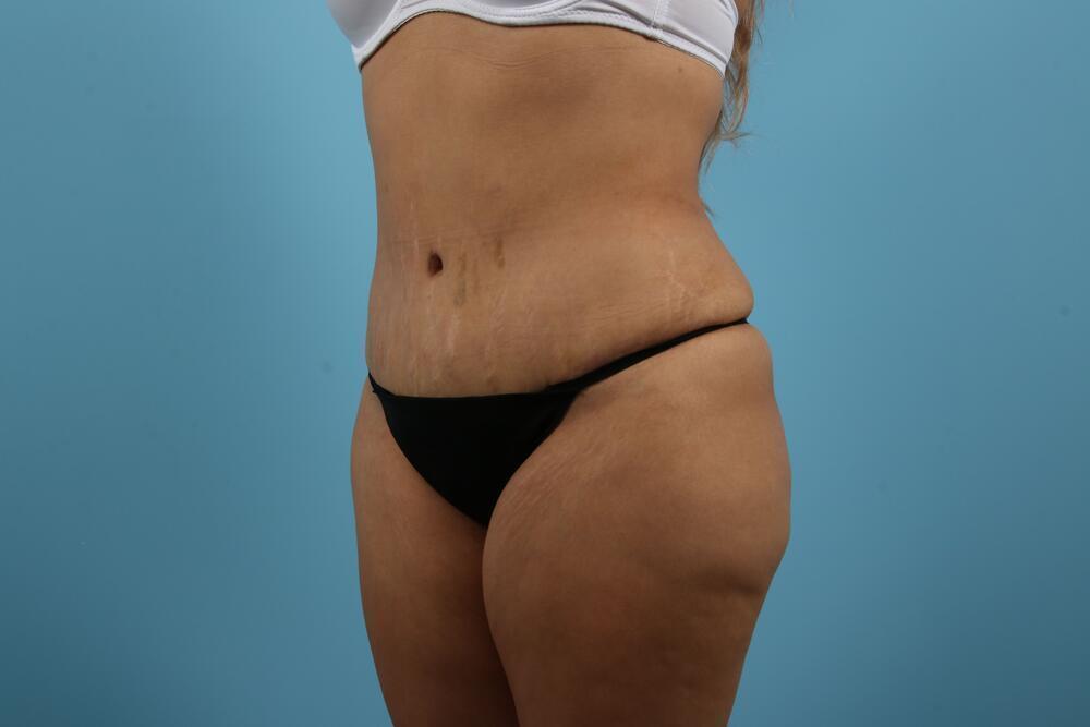 Abdominoplasty Before & After Image