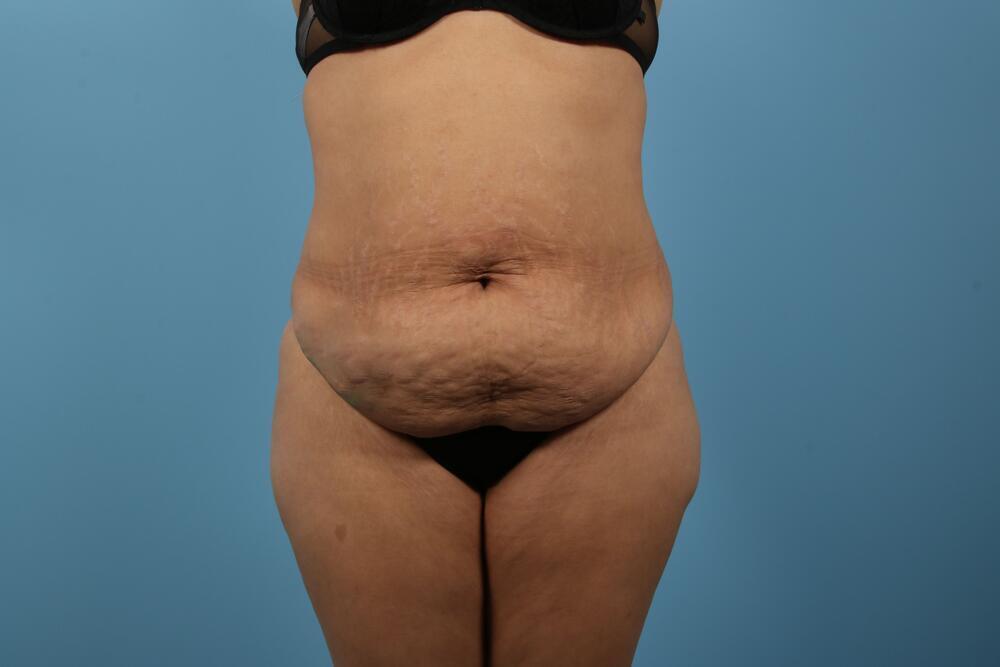 Abdominoplasty Before & After Image