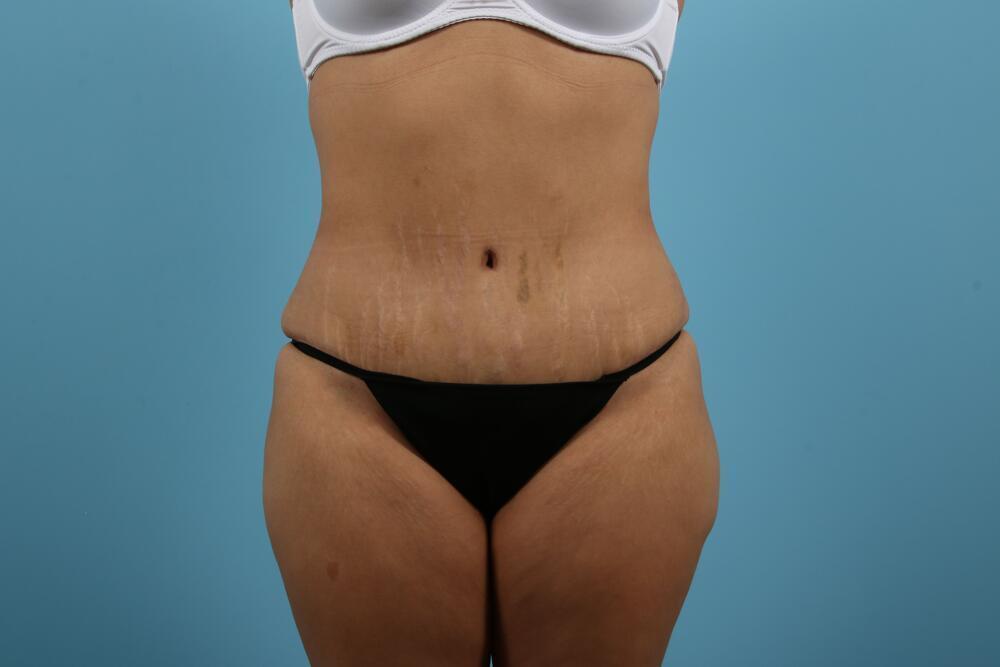 Abdominoplasty Before & After Image