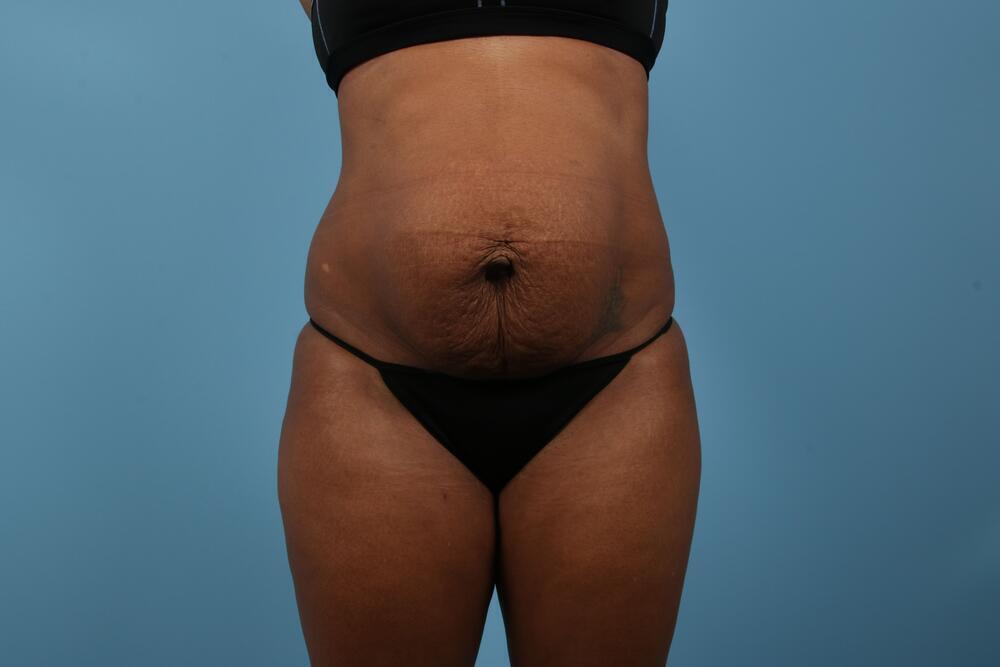 Abdominoplasty Before & After Image