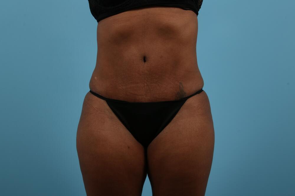 Abdominoplasty Before & After Image