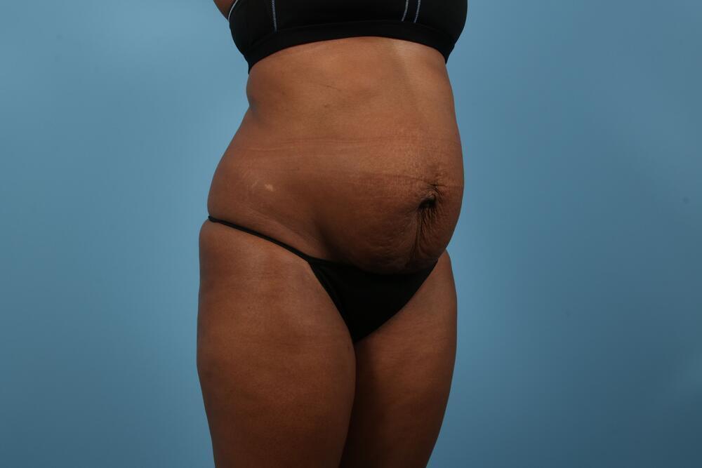 Abdominoplasty Before & After Image