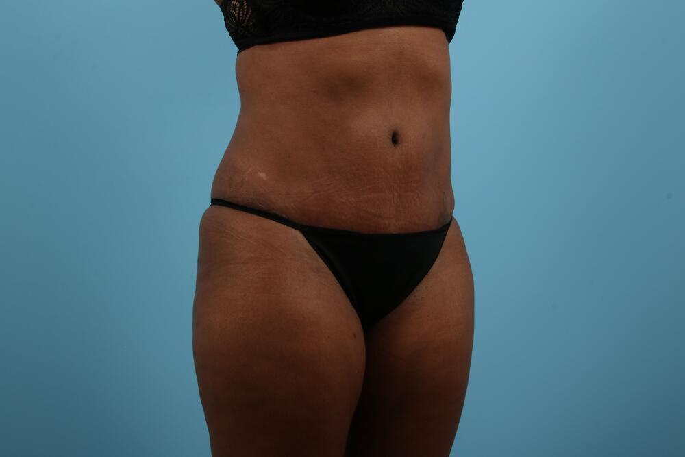 Abdominoplasty Before & After Image