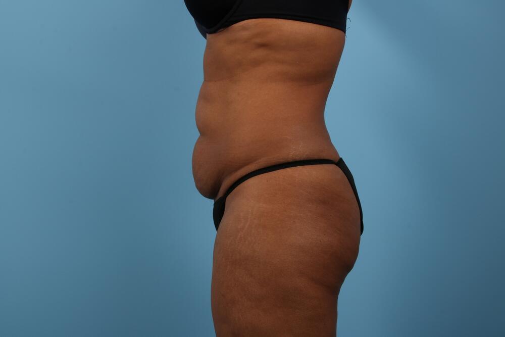 Abdominoplasty Before & After Image