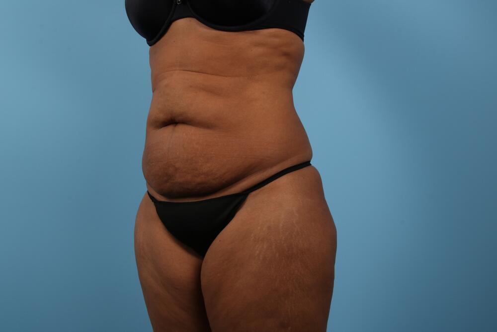 Abdominoplasty Before & After Image