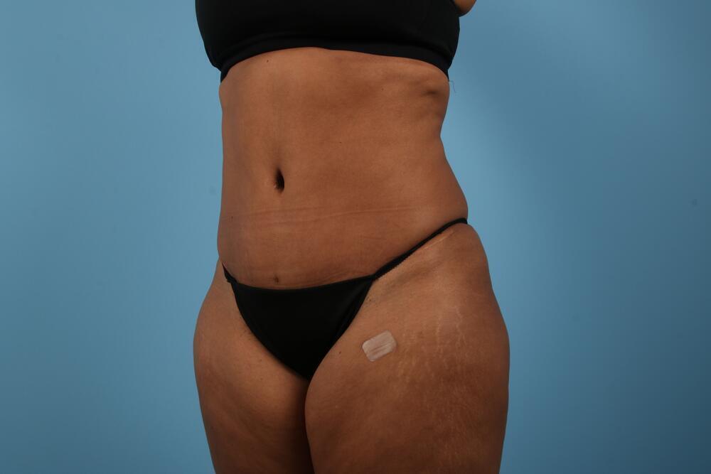 Abdominoplasty Before & After Image