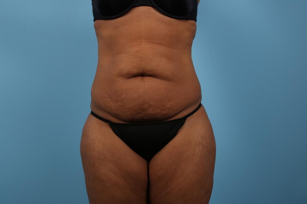 Abdominoplasty Before & After Image