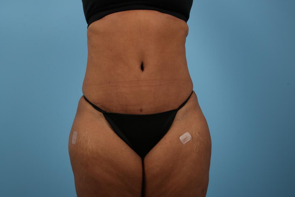 Abdominoplasty Before & After Image