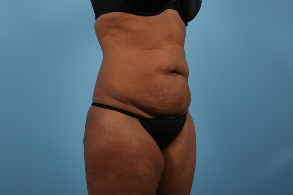 Abdominoplasty Before & After Image