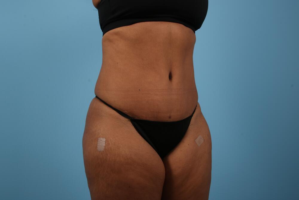 Abdominoplasty Before & After Image