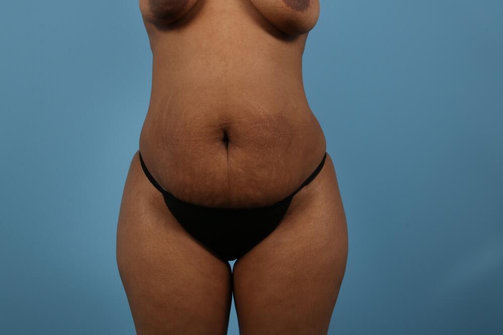 Abdominoplasty Before & After Image