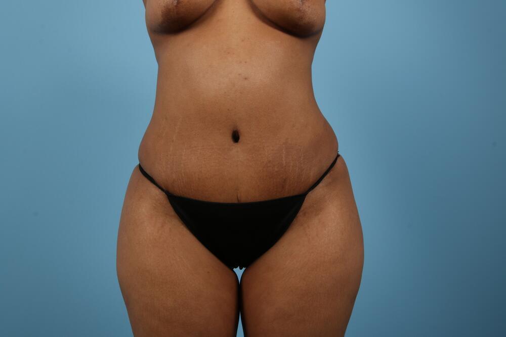 Abdominoplasty Before & After Image