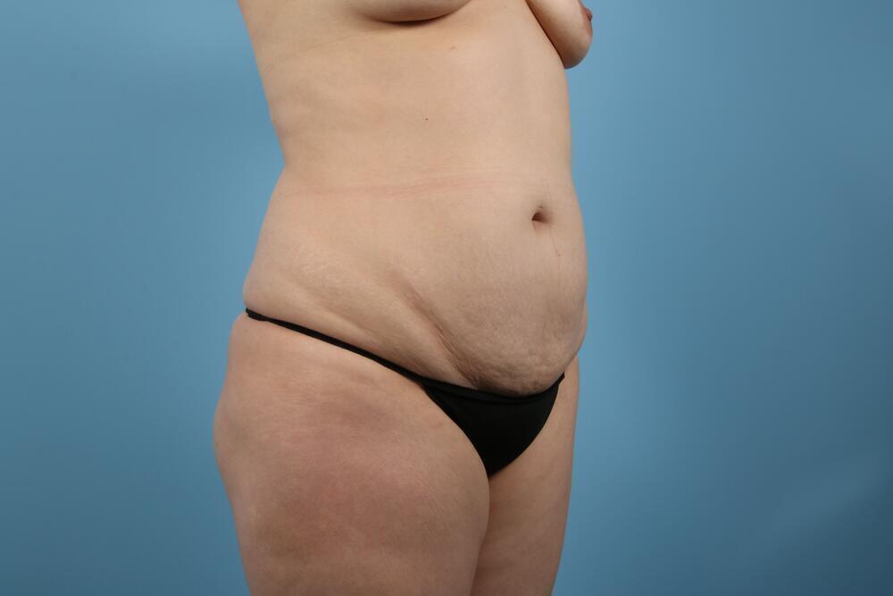 Abdominoplasty Before & After Image