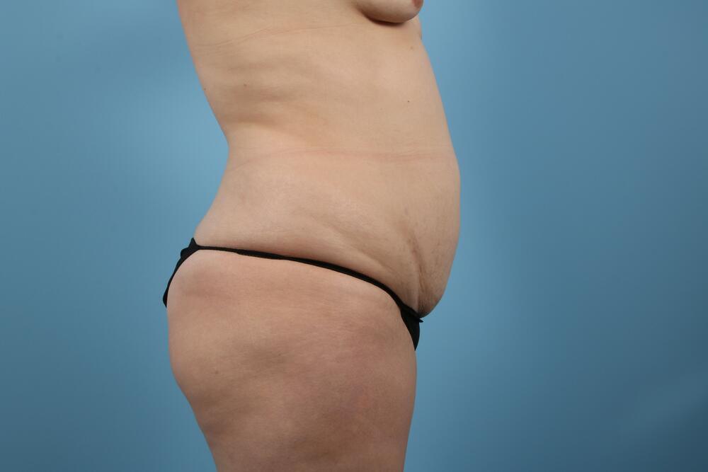 Abdominoplasty Before & After Image