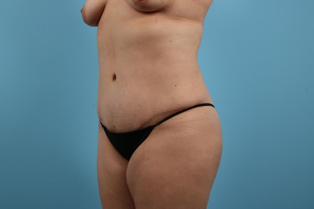 Abdominoplasty Before & After Image