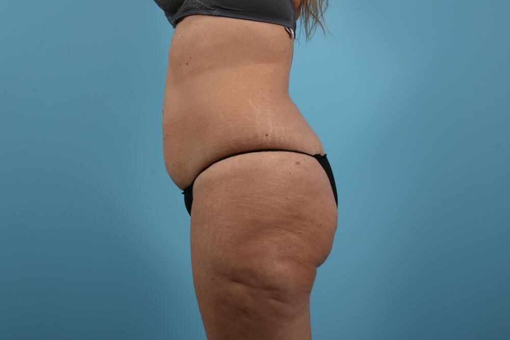 Abdominoplasty Before & After Image