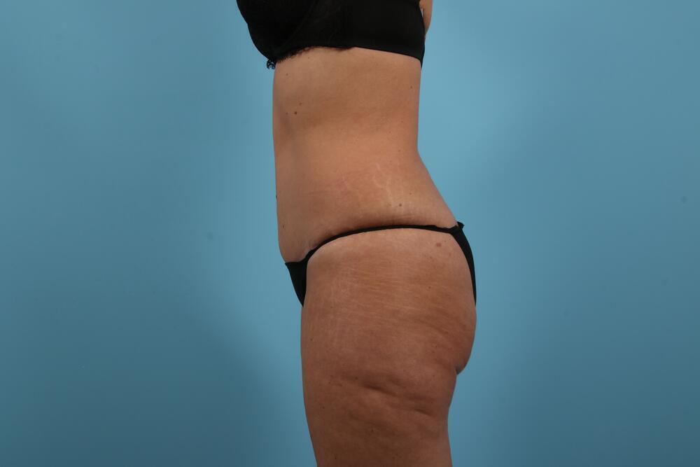 Abdominoplasty Before & After Image