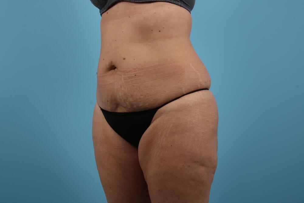 Abdominoplasty Before & After Image