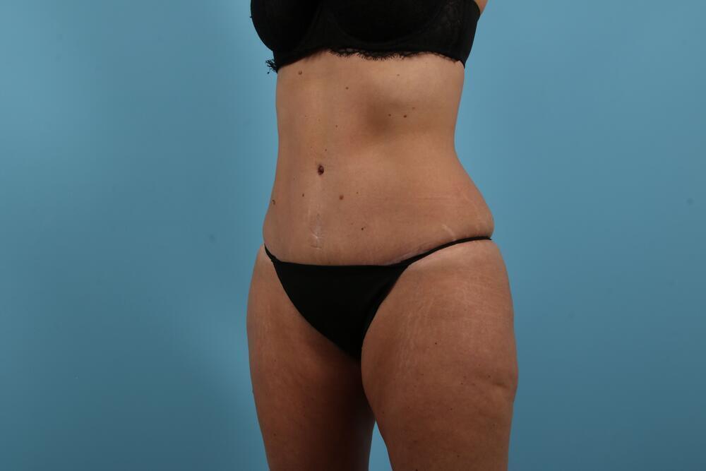 Abdominoplasty Before & After Image